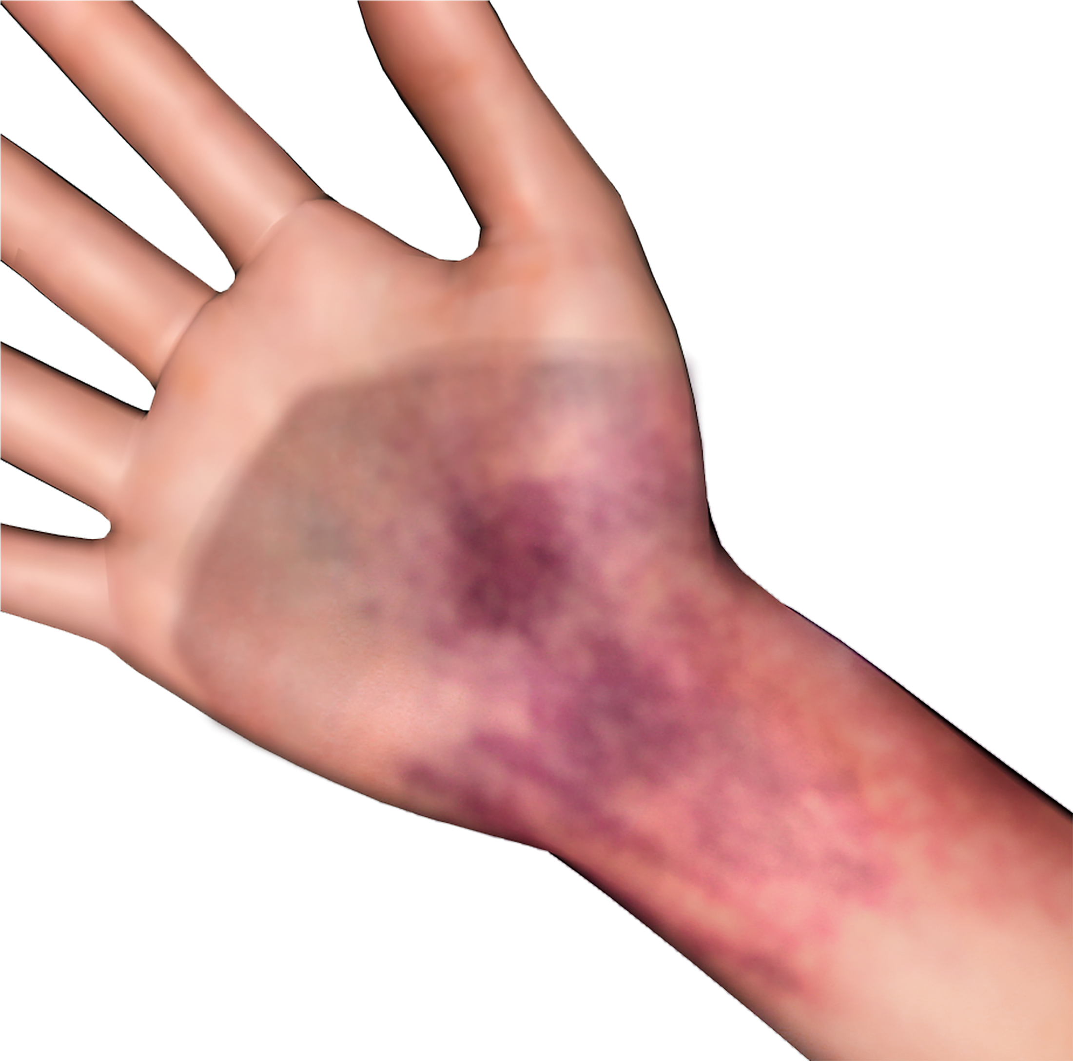 A Hand With A Bruise On It