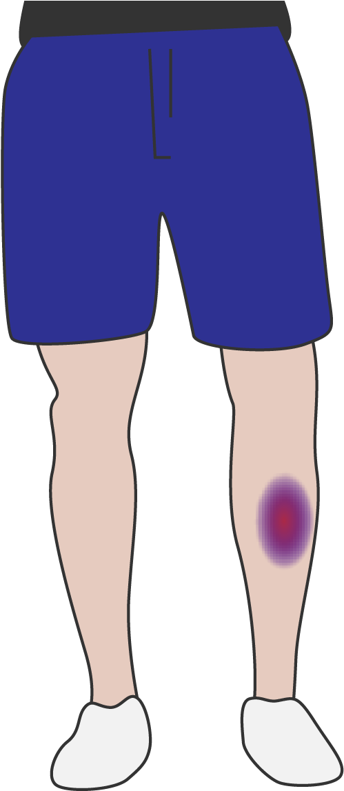 A Person's Legs With Purple Spots