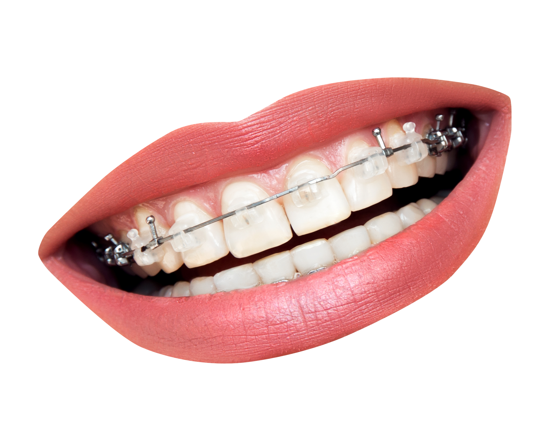 A Close Up Of A Mouth With Braces