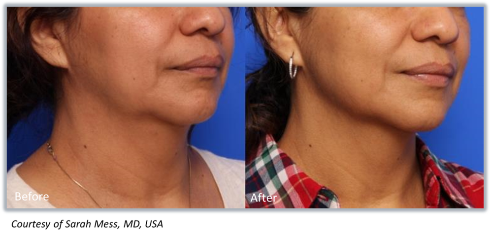 A Woman's Neck Before And After